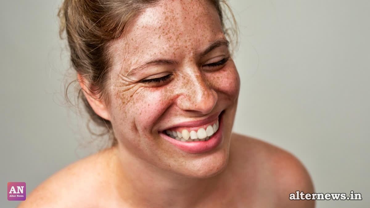 NF1 patients have characteristic café-au-lait spots that look like birthmarks or freckles (Getty Images)