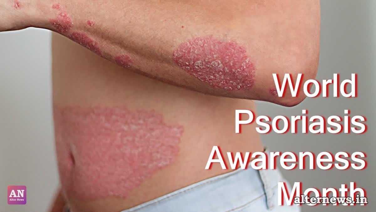 World Psoriasis Awareness Month: Experts Reveal Breakthrough Stem Cell Research and Care Tips